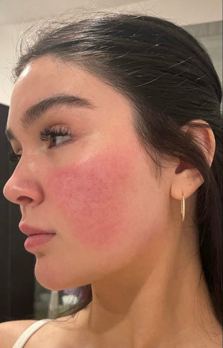 rosacea cheeks